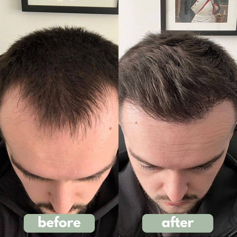 Hair Growth Serum Roll-On (New Formula)